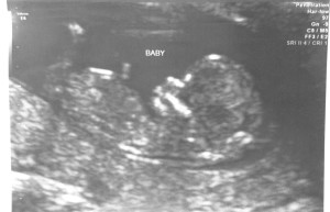 12-week Ultrasound